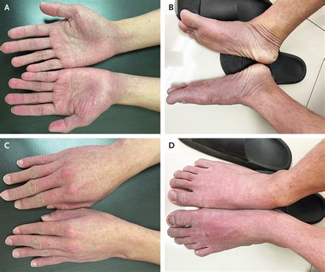 Papular purpuric gloves and socks syndrome